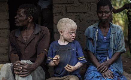 An albino child sits between his parents in the traditional authority area of Nkole, Machinga district, Malawi.