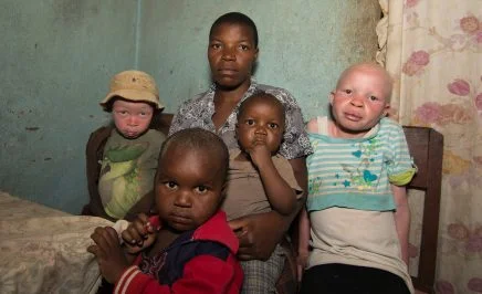 A family in Malawi with one Albino child